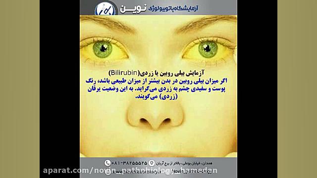 آزمایش بیلی روبین یا زردی(Bilirubin) آزمایشگاه پاتوبیولوژی نوین همدان