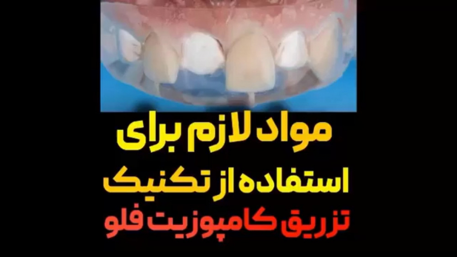 مواد لازم برای استفاده از تکنیک تزریق کامپوزیت فلو زوترلینیب