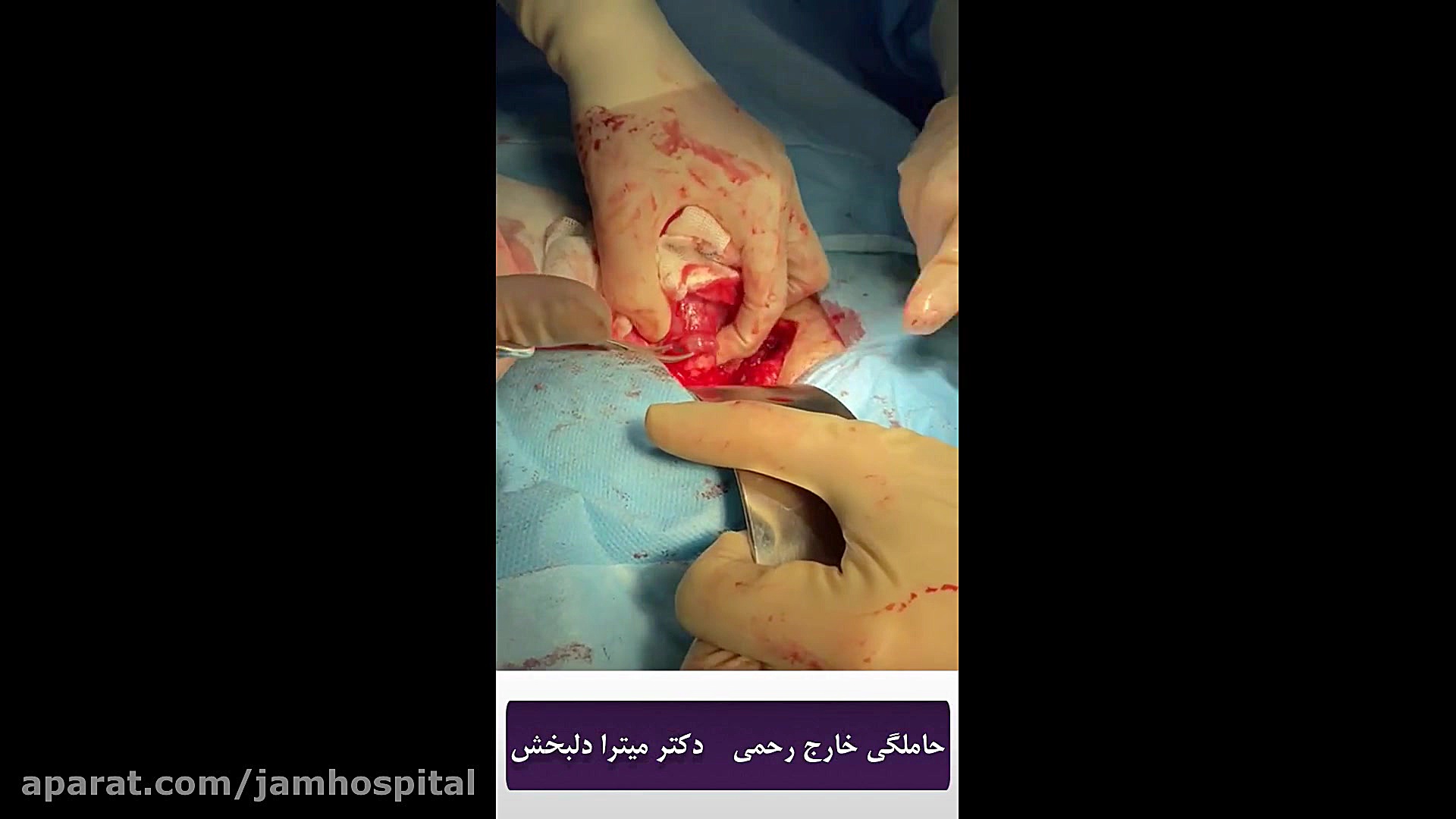 حاملگي خارج رحمي، بيمارستان فوق تخصصي جم، دكتر ميترا دلبخش متخصص زنان و زايمان دندانپزشکی کودکان