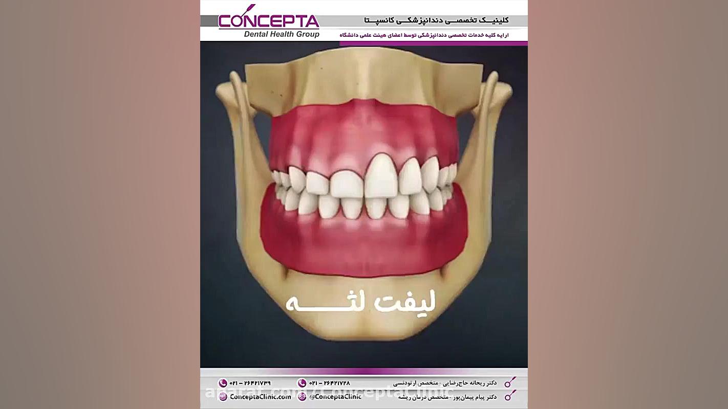 افزایش طول تاج دندان با لیزر | کلینیک تخصصی دندانپزشکی کانسپتا اریتروبلاستوز جنینی