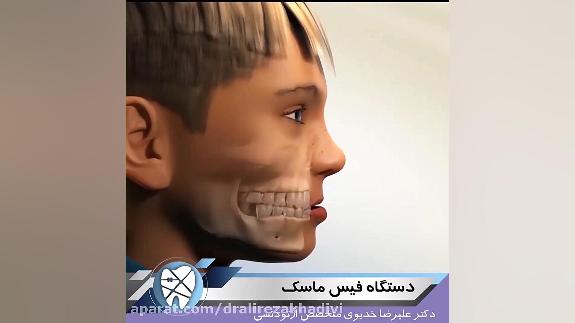دستگاه فیس ماسک.متخصص ارتودنسی تهران.دکترعلیرضاخدیوی دکتر علیرضا خدیوی