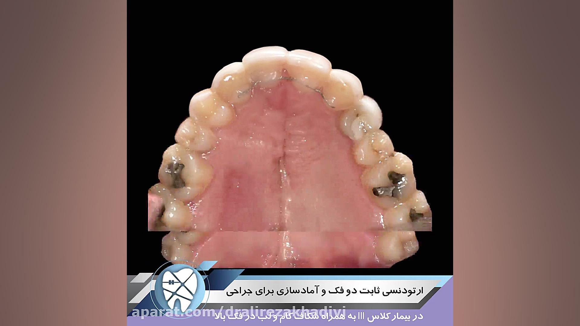 ارتودنسی ثابت دو فک و آماده سازی برای جراحی.متخصص ارتودنسی تهران.دکترعلیرضاخدیوی دکتر علیرضا خدیوی