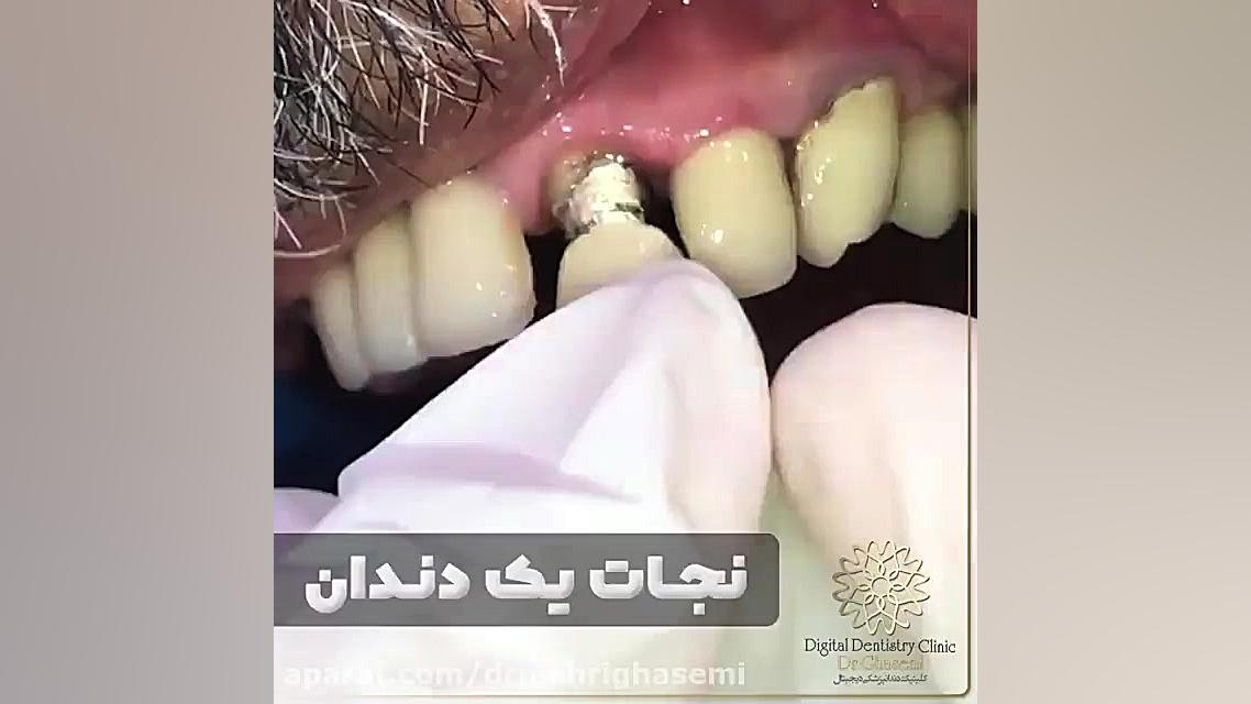 نجات دندانی که باید کشیده میشد! | کلینیک دندانپزشکی دیجیتال دکتر مهری قاسمی مرکز دندانپزشکی دیجیتال دکتر مهری قاسمی
