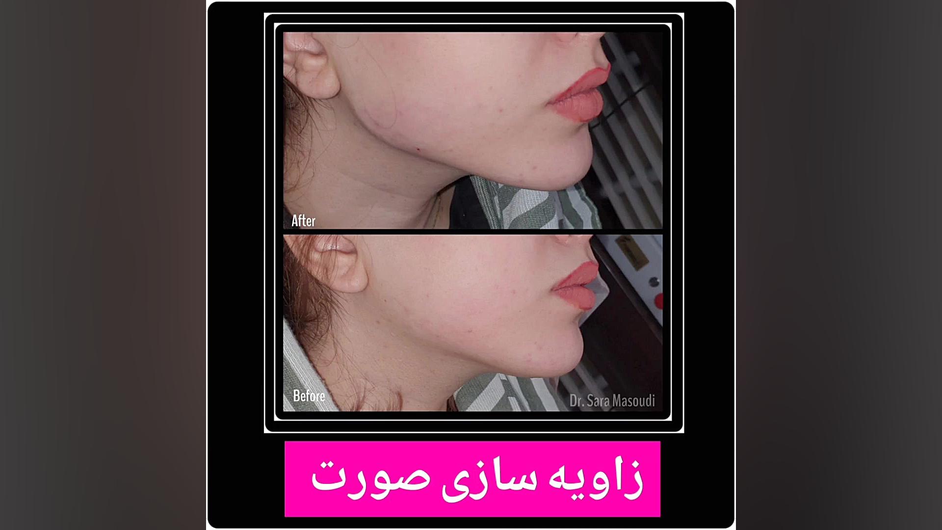 زاویه سازی صورت،تزریق ژل گلوسودینیا