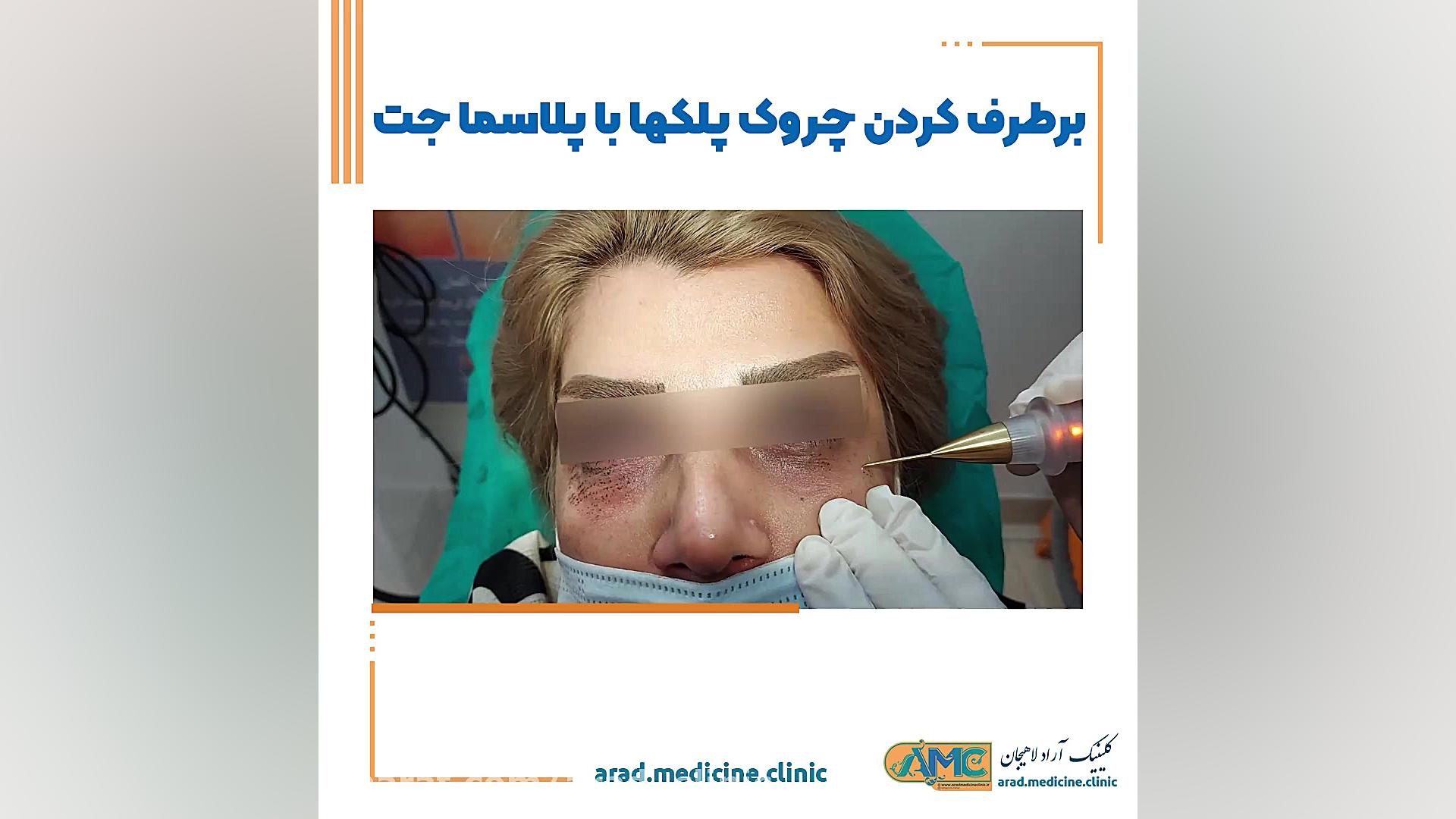 برطرف کردن چروک پلک ها با پلاسما جت اکستنشن تاج دندان