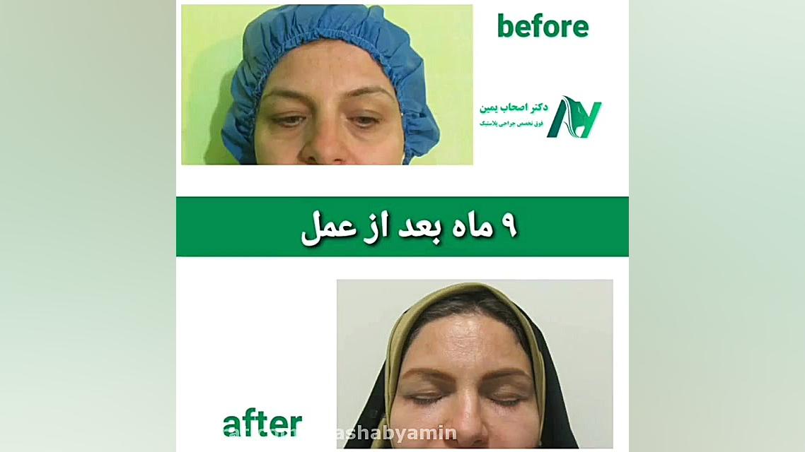 عمل بلفاروپلاستی پلک پایین توسط دکتر اصحاب یمین دکتر محمودرضا اصحاب یمین - فوق تخصص پلاستیک