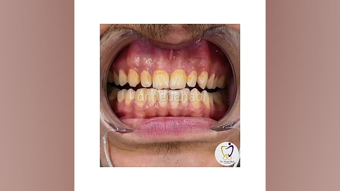 لبخند زیباجوی عزیزمون دکتر ندا هادی-دندانپزشک زیبایی