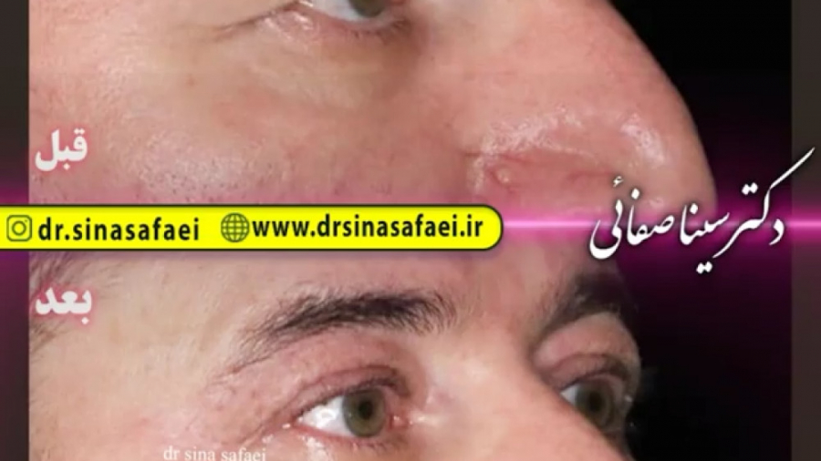 پلاسما جت پلک فوقانی هایپررفلکسی