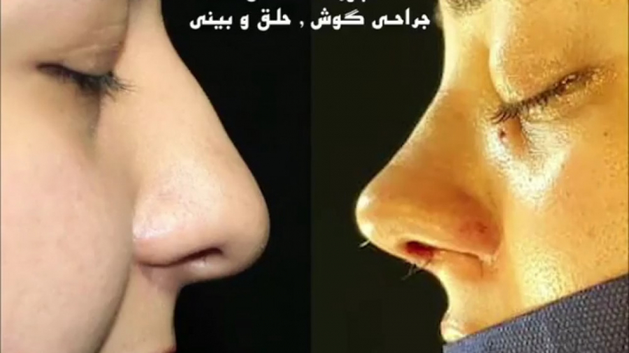 رینوپلاستی بینی گوشتی توسط دکتر امید ابراهیمی بهترین جراح بینی در تهران دکتر امید ابراهیمی