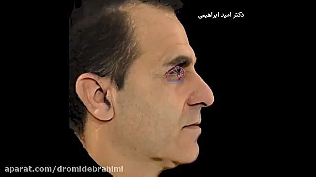 شبیه سازی جراحی بینی و عمل طبیعی مردانه دکتر امید ابراهیمی