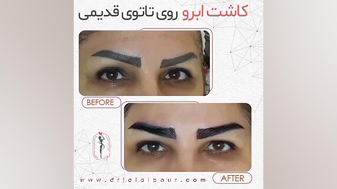 کاشت ابرو روی تاتوی قدیمی هایفوتراپی
