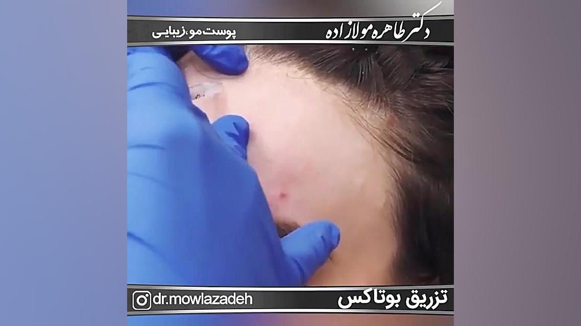 فیلم تزریق بوتاکس پان‌سیتوپنی