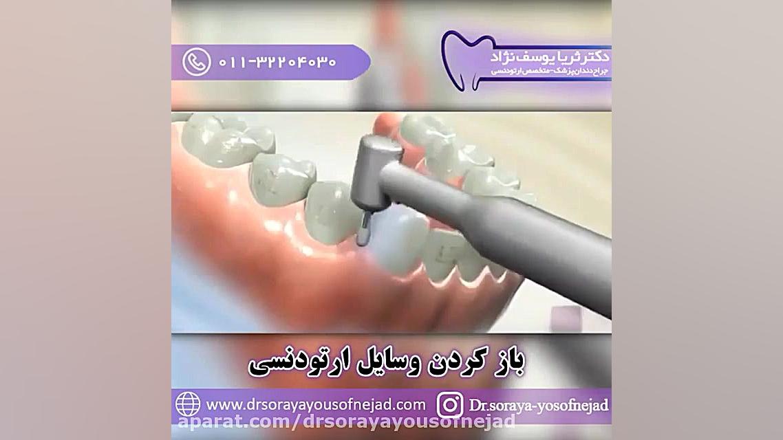 باز کردن وسایل ارتودنسی دکتر ثریا یوسف نژاد متخصص ارتودنسی بابل
