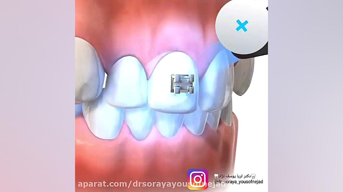 مراحل نصب براکت ارتودنسی دکتر ثریا یوسف نژاد متخصص ارتودنسی بابل