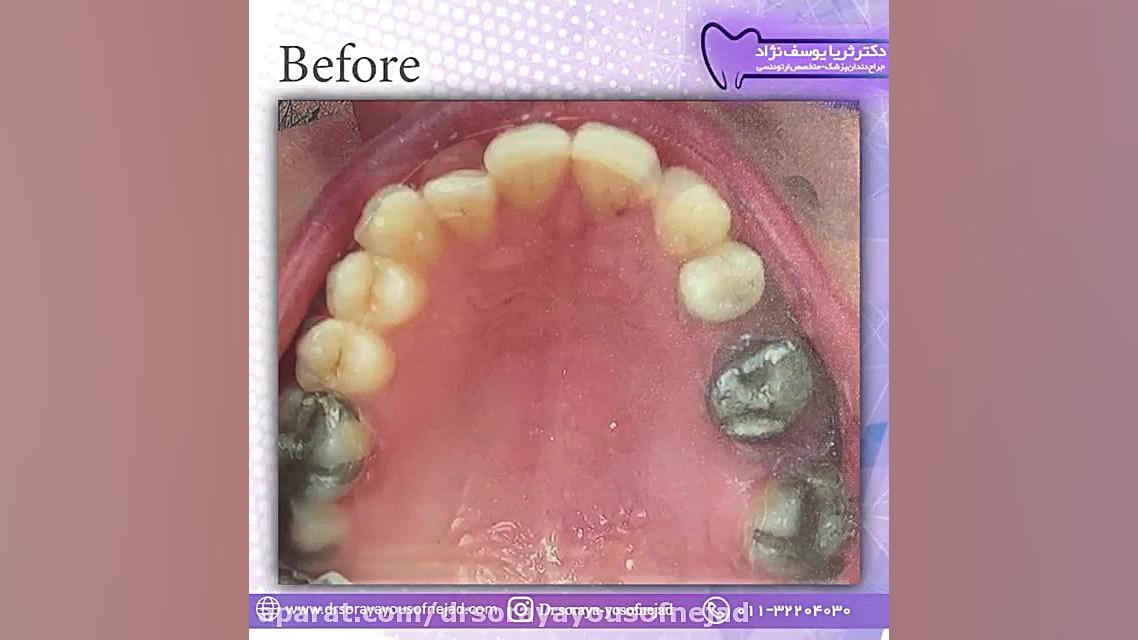 ارتودنسی ثابت دکتر ثریا یوسف نژاد متخصص ارتودنسی بابل