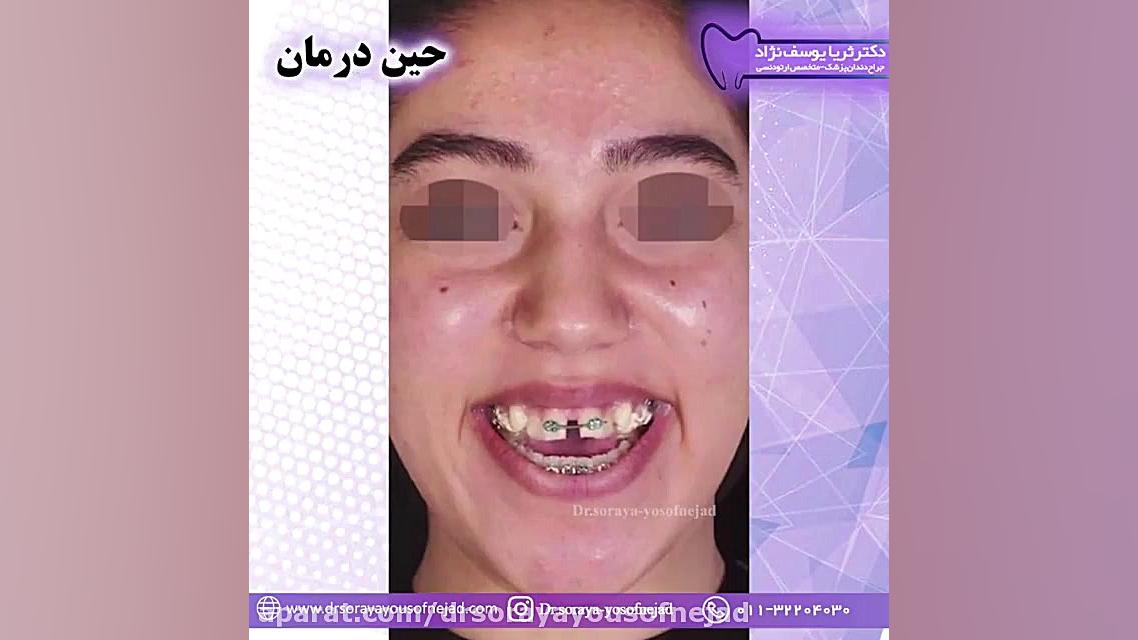 درمان ارتودنسی ثابت دکتر ثریا یوسف نژاد متخصص ارتودنسی بابل