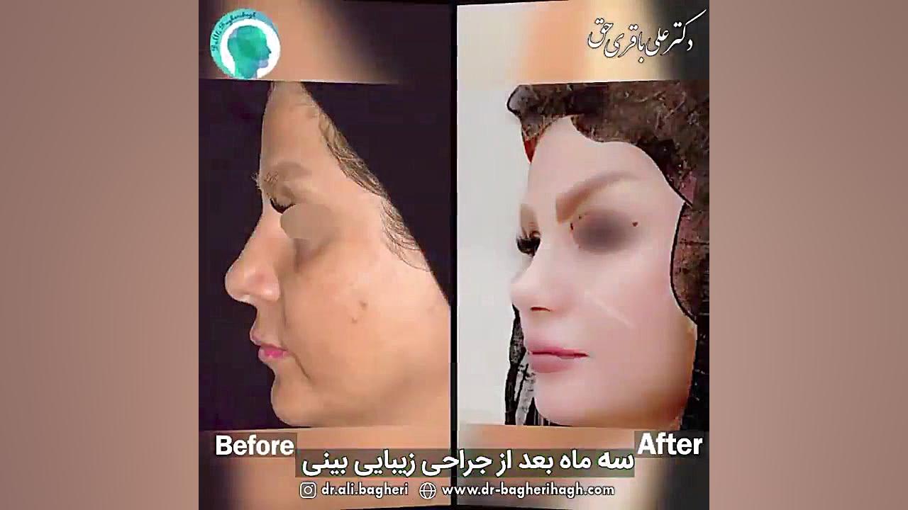 قبل و بعد از جراحی زیبایی بینی دکتر علی باقری حق