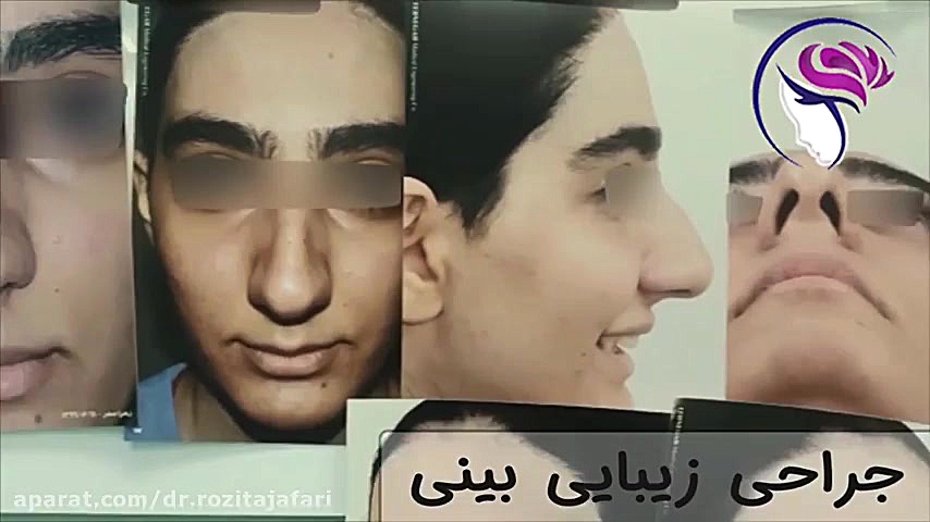 فیلم واقعی عمل زیبایی بینی کاشت ابرو