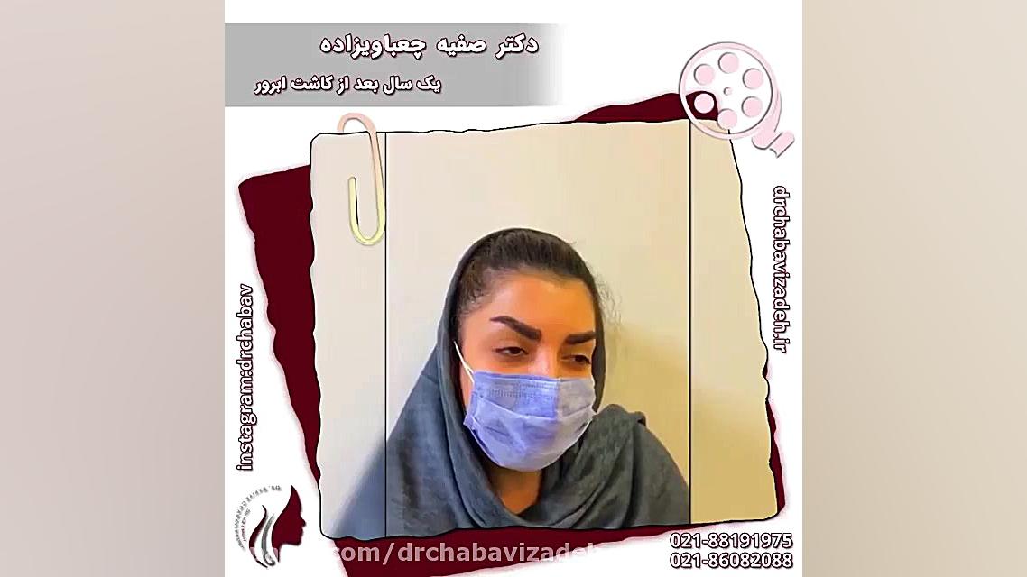 فیلم نتیجه کاشت ابرو بعد از 1 سال دکتر صفیه چعباوی زاده