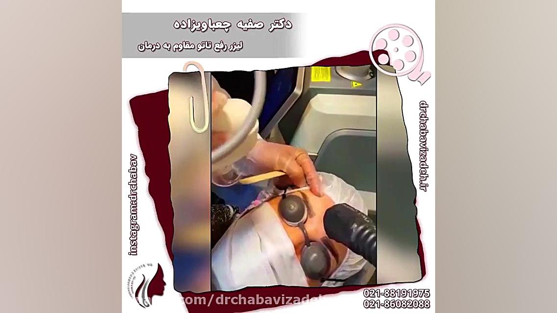 فیلم واقعی پاک کردن تاتو با لیزر دکتر صفیه چعباوی زاده