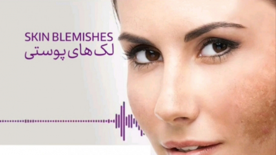 راه های درمان لک های پوستی و انواع لک کلینیک زیبایی