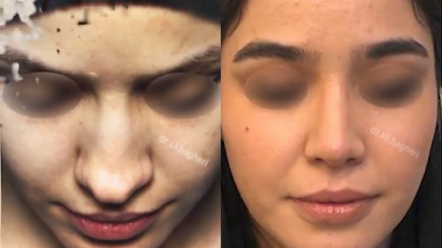 جراحی بینی توسط دکتر باقری حق دکتر علی باقری حق