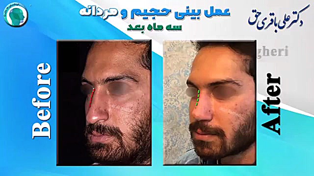 قبل و سه ماه بعد جراحی بینی حجیم و مردانه دکتر علی باقری حق