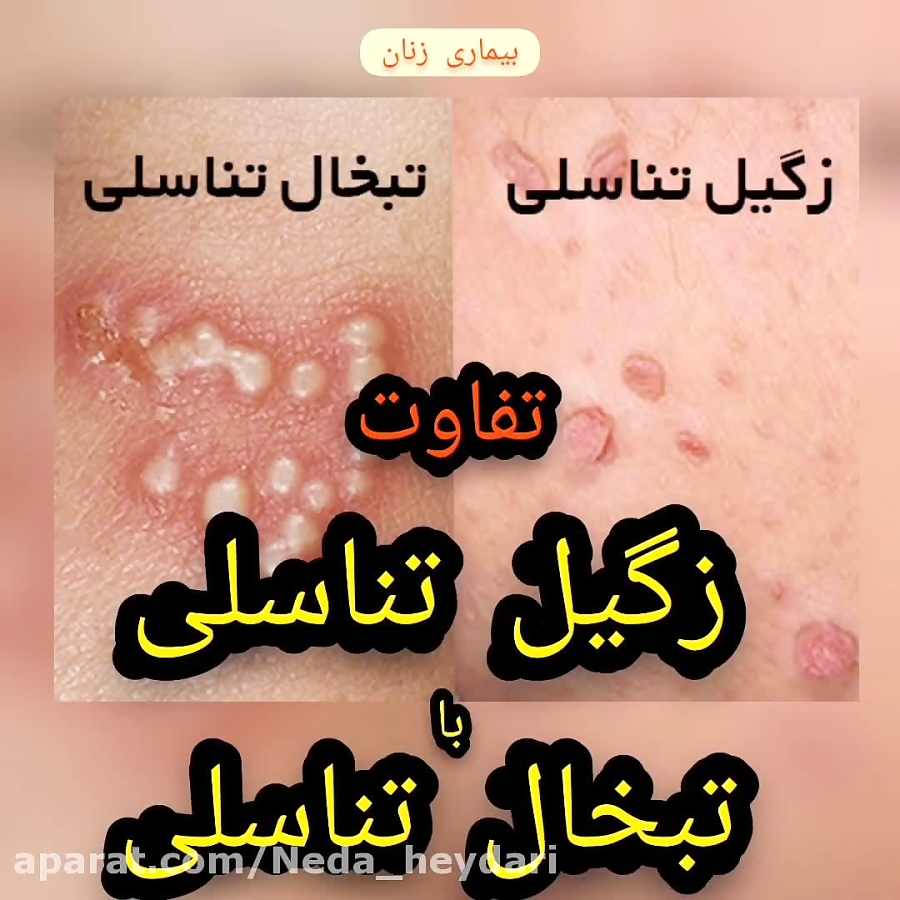 تفاوت زگیل تناسلی با تبخال تناسلی تفاوت زگیل تناسلی با تبخال تناسلی