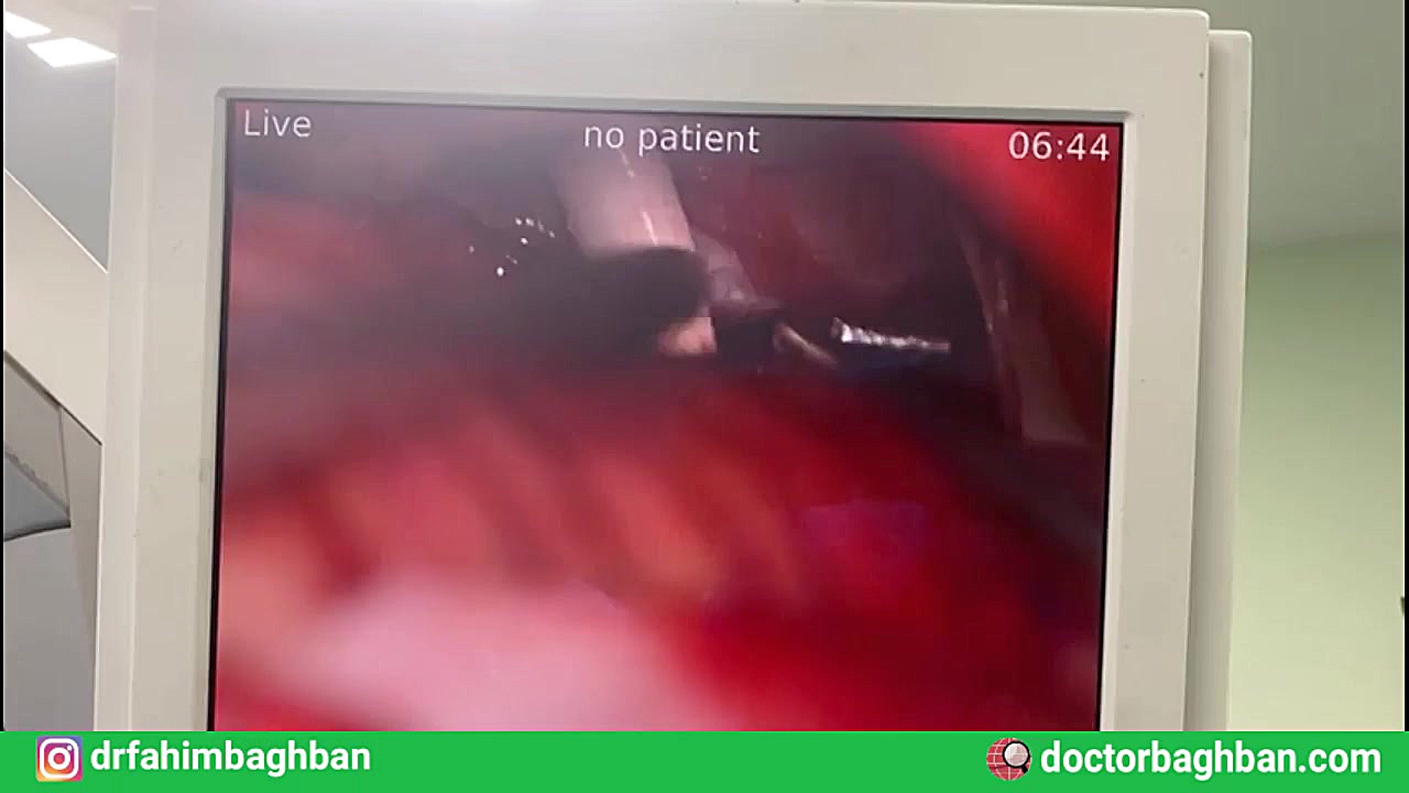 جراحی همی فاشيال اسپاسم پادکست