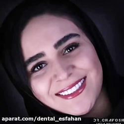 ماندگاری کامپوزیت دندان