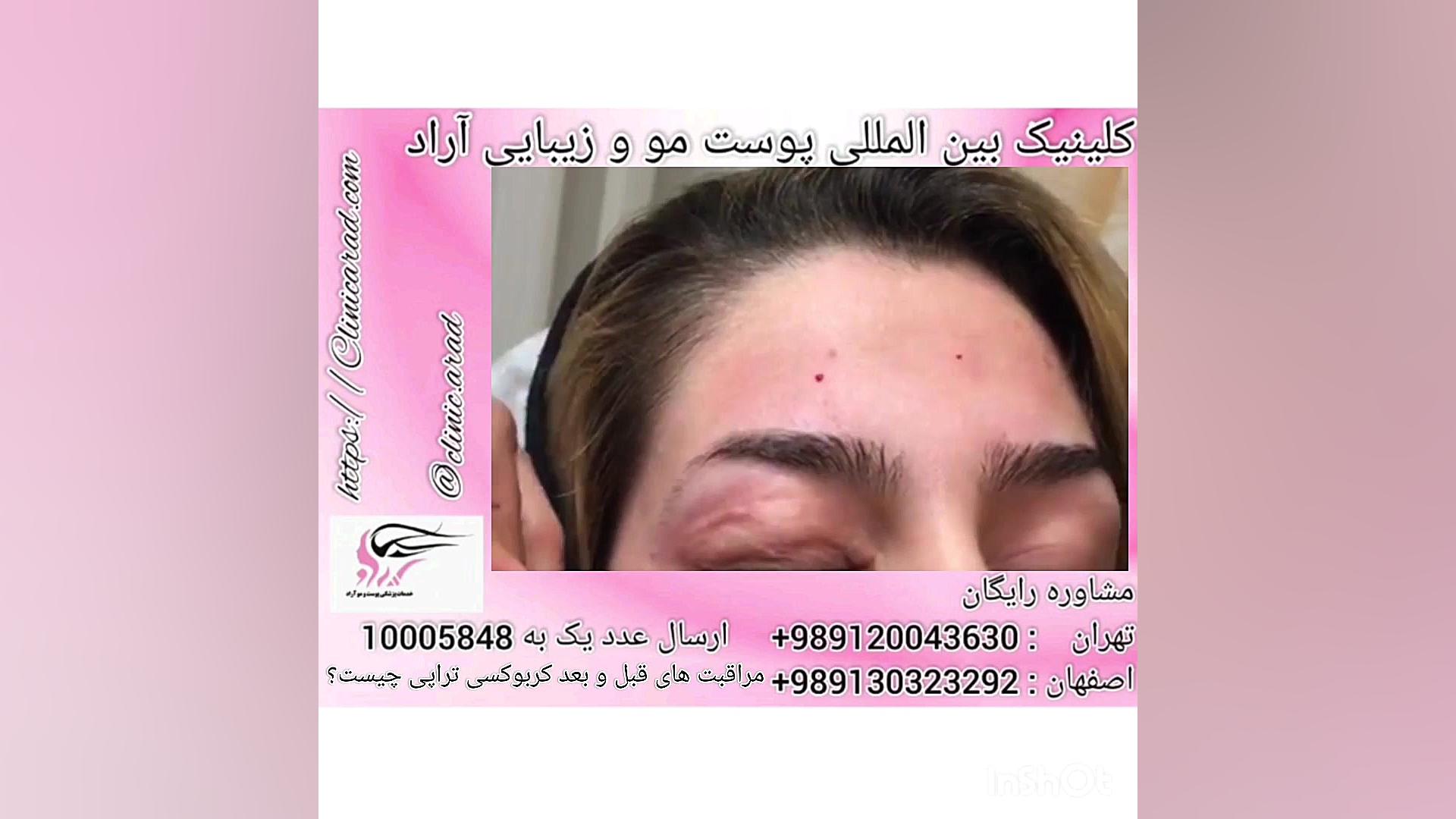 مراقبت های قبل و بعد کربوکسی تراپی چیست؟ ویروس‌شناسی انسانی