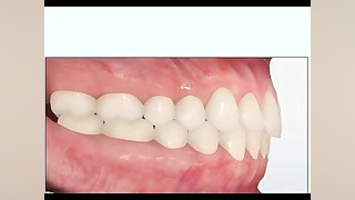 مشکلات متداول ارتودنسی کراس بایت دکتر سهیل سالاری