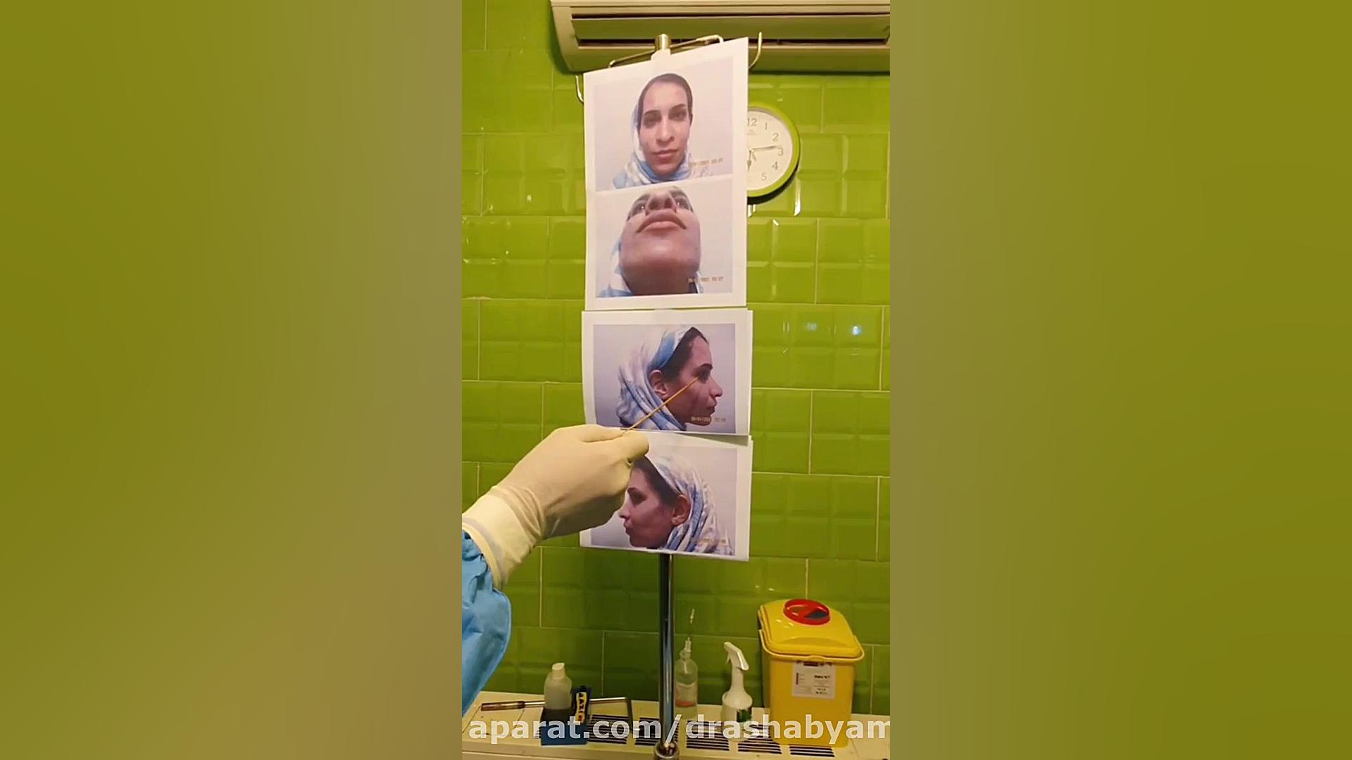 جراحی بینی کاملا گوشتی توسط دکتر اصحاب یمین دکتر محمودرضا اصحاب یمین - فوق تخصص پلاستیک