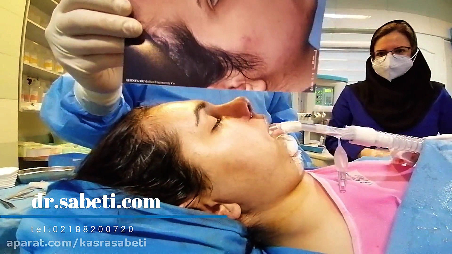 این ویدیو شامل صحنه اتاق عمل است برداشتن قوز بینی برای ایجاد قوس ماموپلاستی