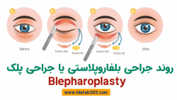 جراحی پلک در اصفهان | چگونگی روند درمان در بلفاروپلاستی