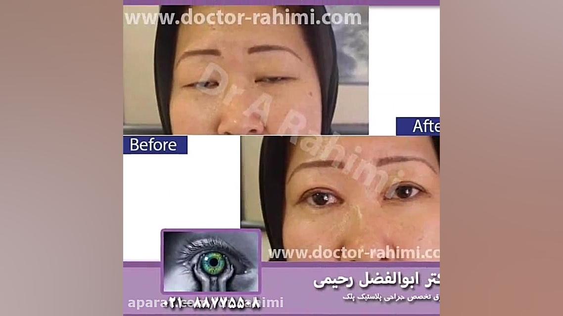 جراحی زیبایی چشم شرقی پروتز سینه