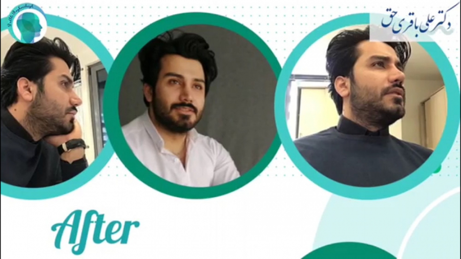 سه سال بعد از جراحی بینی حجیم با پوست نسبتا ضخیم دکتر علی باقری حق