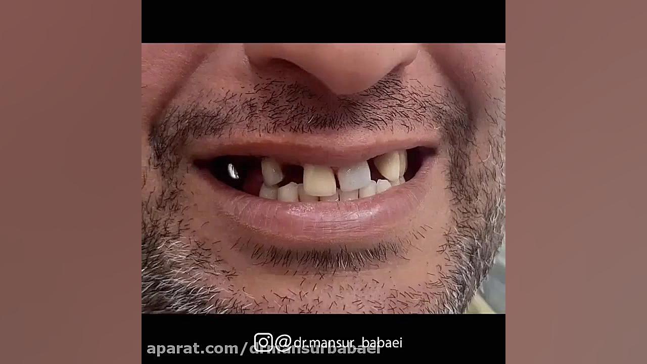 بازسازی کامل فک بالا بوسیله روکش های PFM دکتر منصور بابایی
