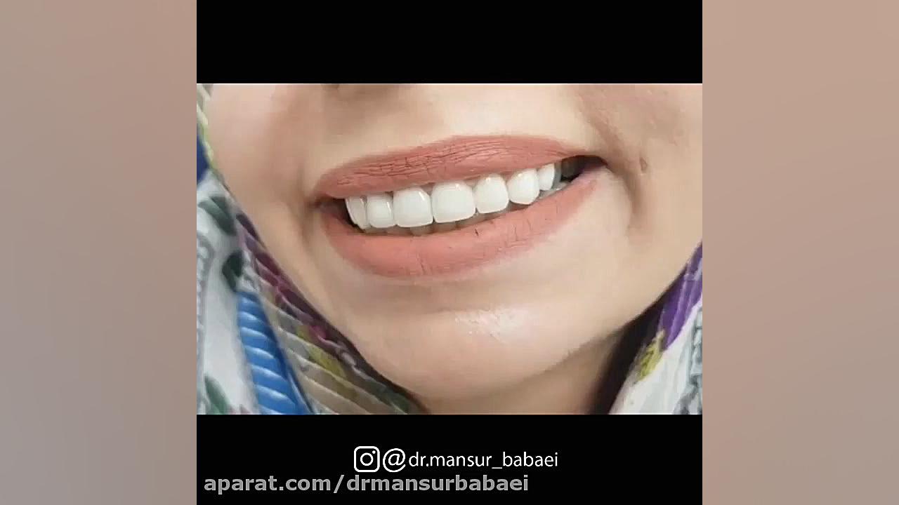 ۸ واحد روکش و لمینیت سرامیکی برای مراجعه کننده عزیز دکتر منصور بابایی