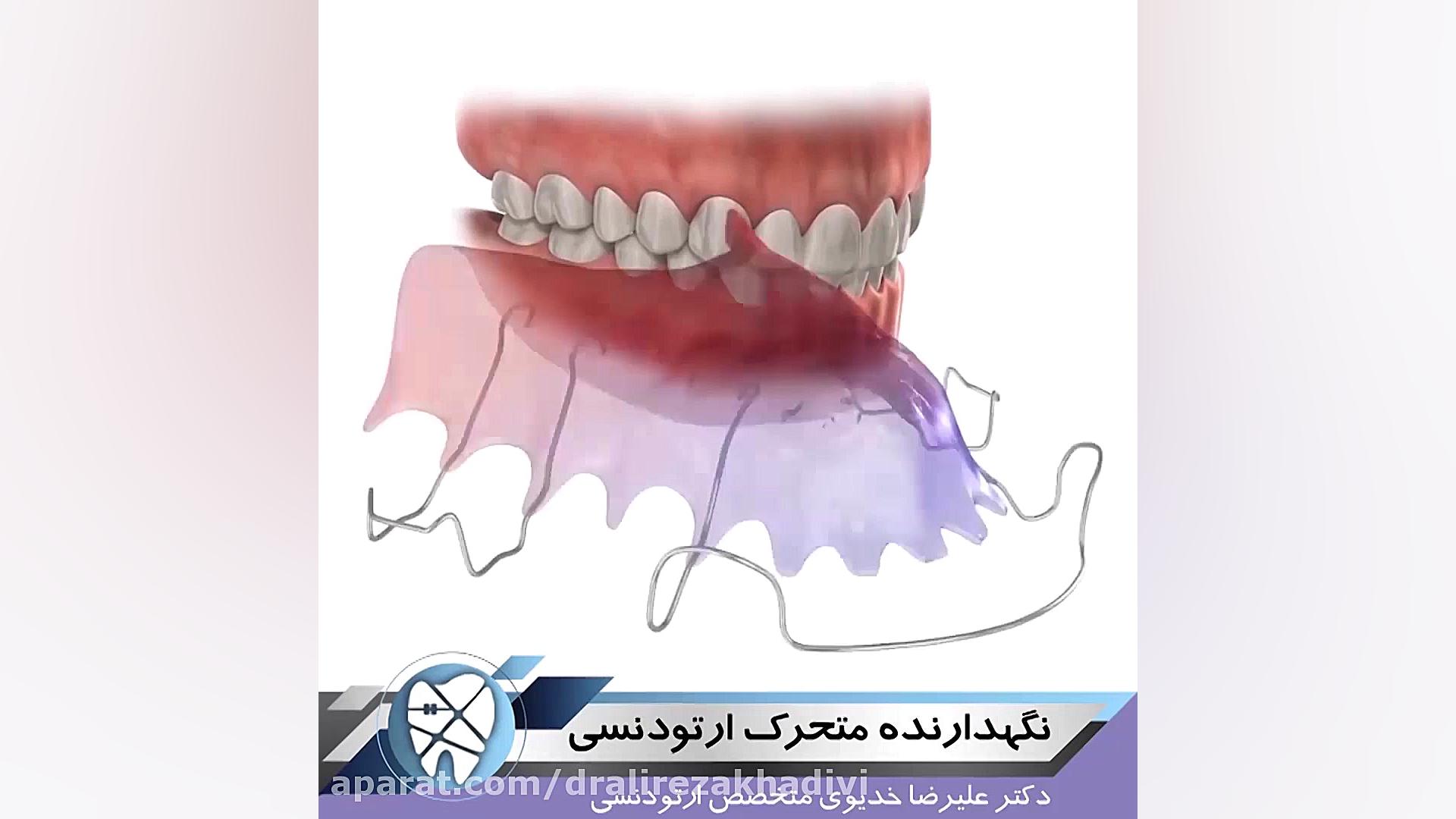 نگهدارنده متحرک ارتودنسی دکتر علیرضا خدیوی