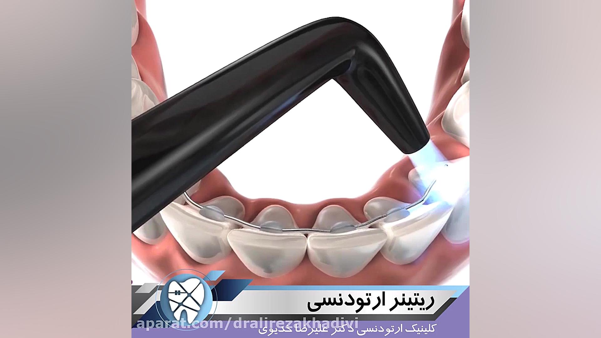 ریتینر ارتودنسی.متخصص ارتودنسی تهران.دکترعلیرضاخدیوی دکتر علیرضا خدیوی