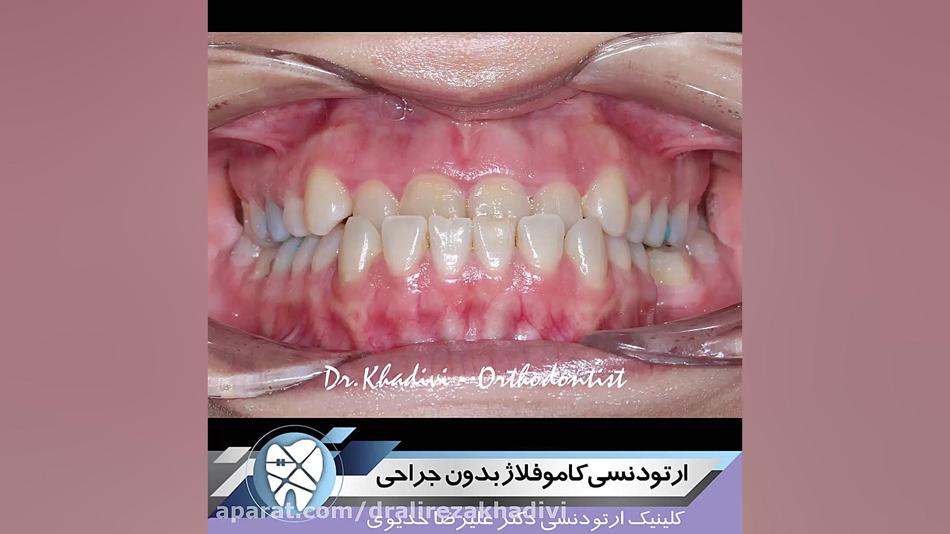 ارتودنسی کاموفلاژ بدون جراحی.متخصص ارتودنسی تهران.دکترعلیرضاخدیوی دکتر علیرضا خدیوی