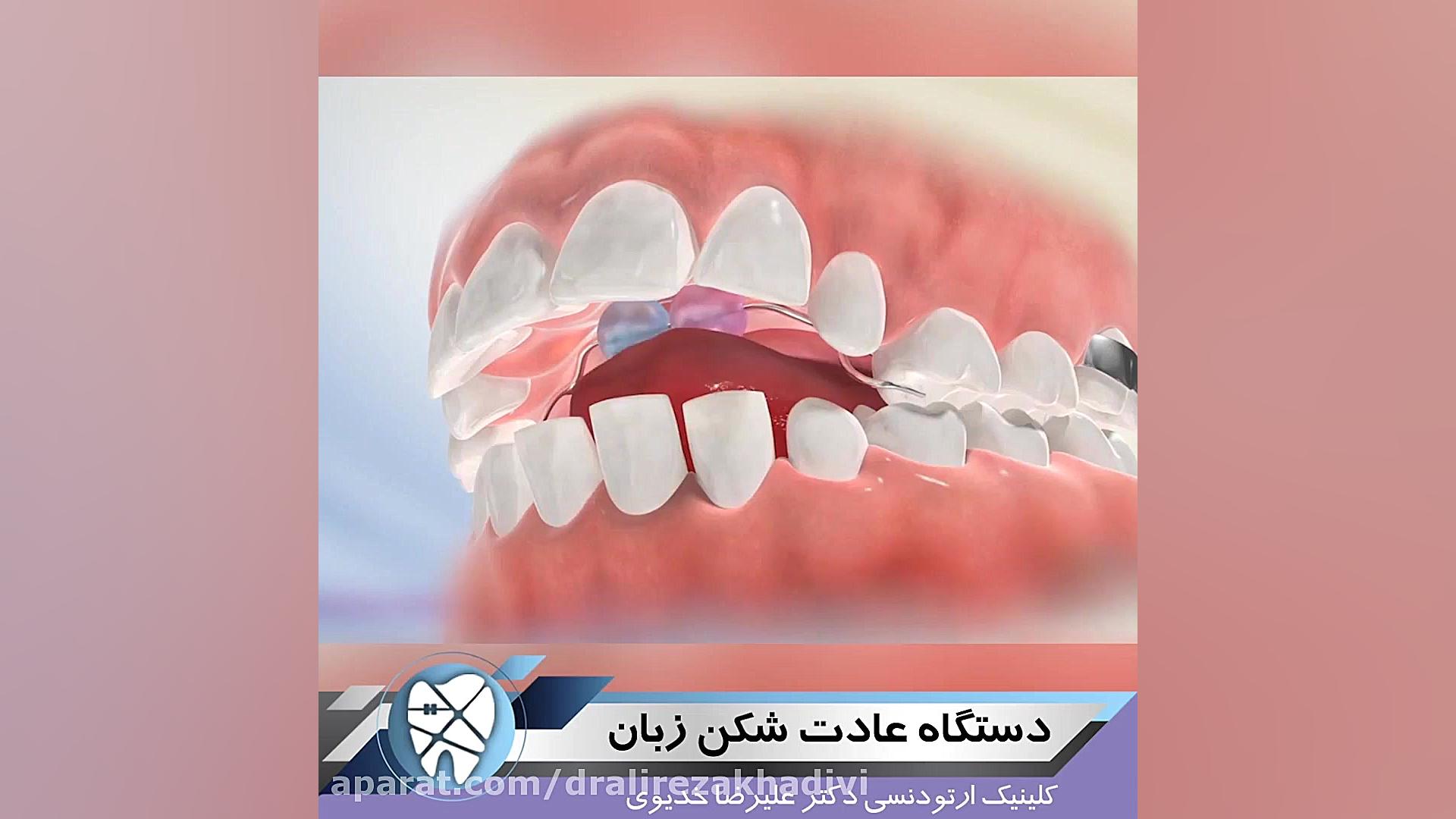 دستگاه عادت شکن زبان.متخصص ارتودنسی تهران.دکترعلیرضاخدیوی دکتر علیرضا خدیوی