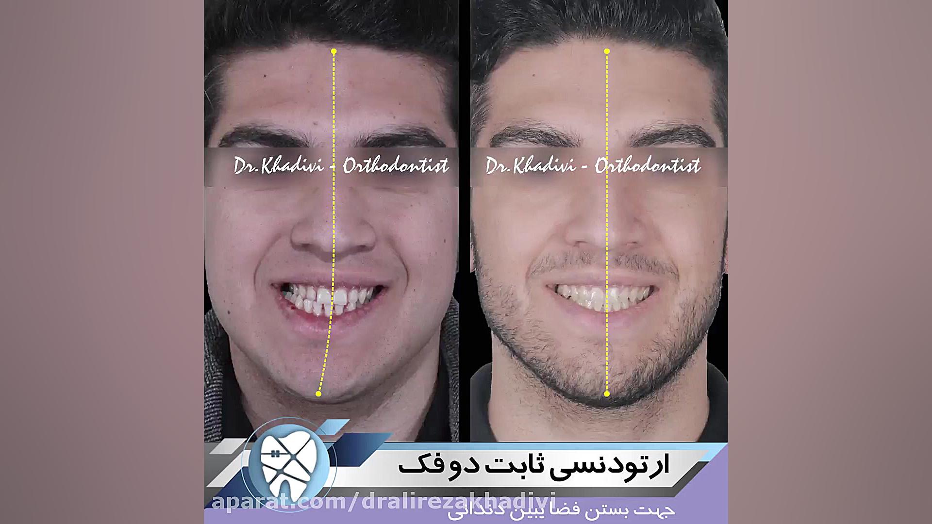 ارتودنسی ثابت دو فک.متخصص ارتودنسی تهران.دکترعلیرضاخدیوی دکتر علیرضا خدیوی