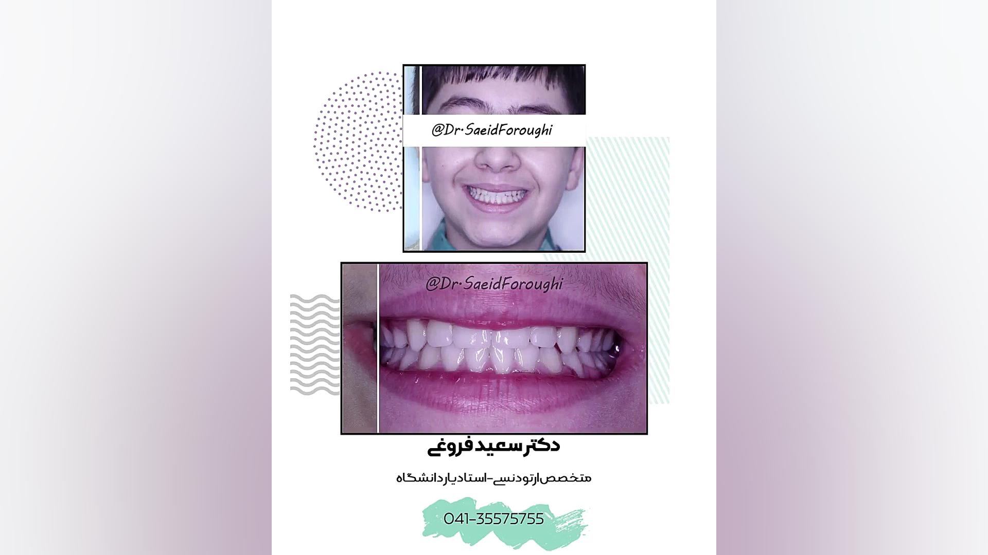 ارتودنسی ثابت دکتر سعید فروغی متخصص ارتودنسی