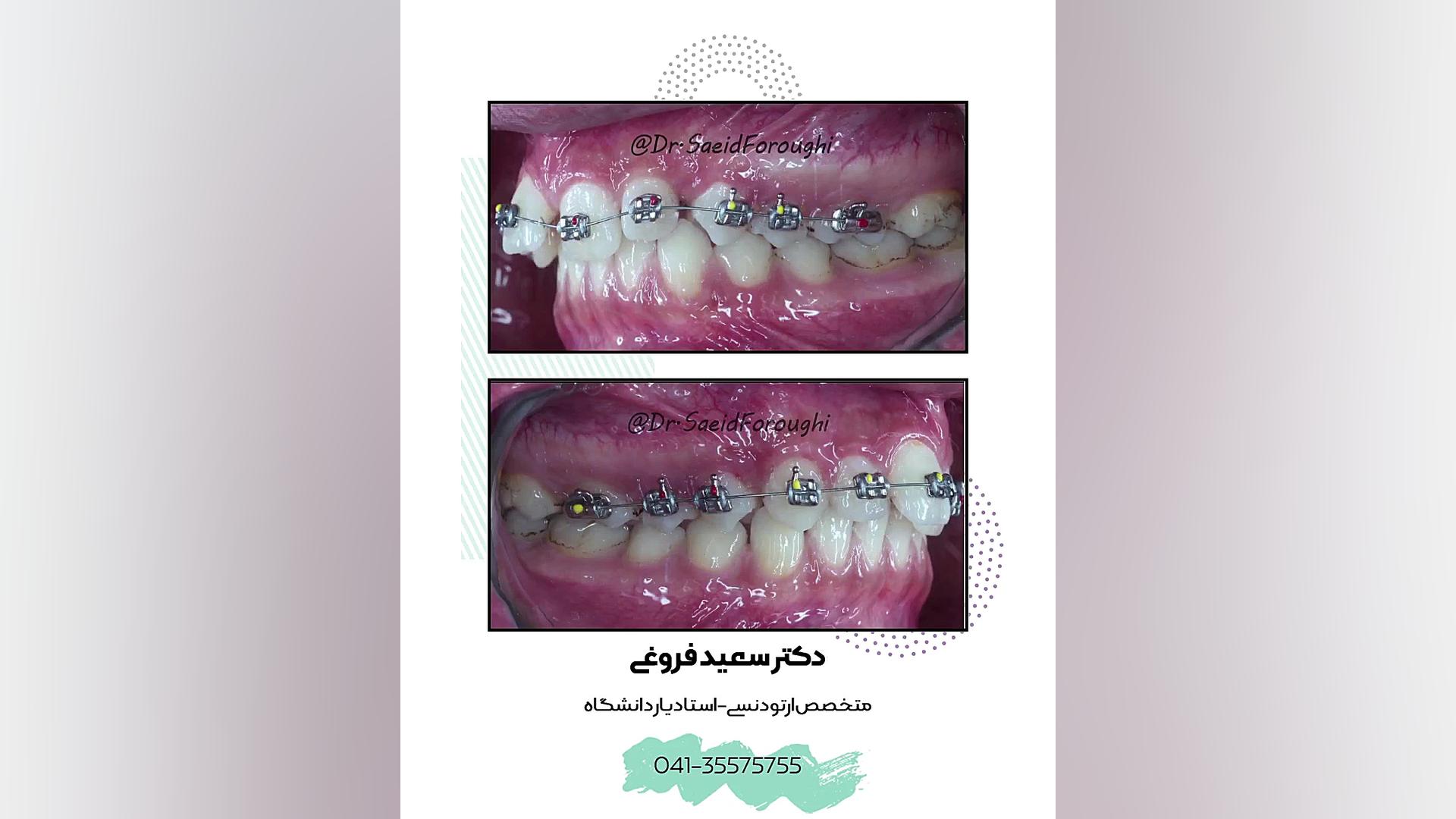 ارتودنسی ثابت دکتر سعید فروغی متخصص ارتودنسی
