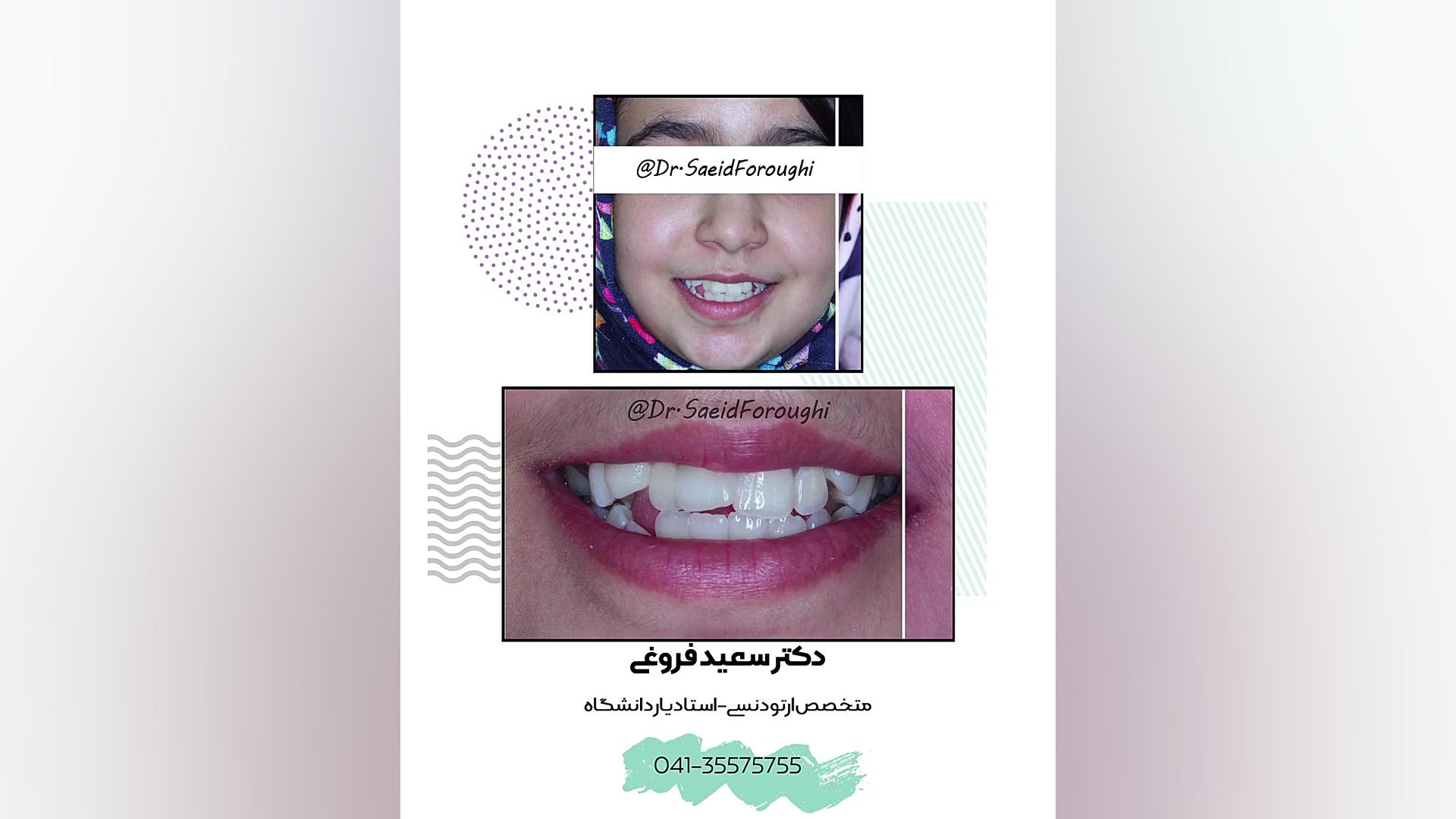 ارتودنسی ثابت دکتر سعید فروغی متخصص ارتودنسی