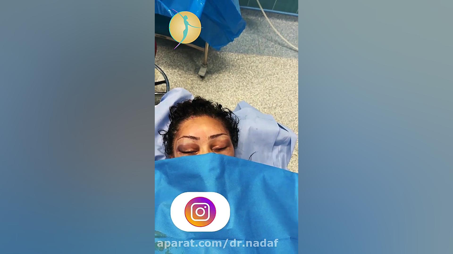 جراحی لیفت ابرو اندوسکوپیک با اندوتاین دندان پیش