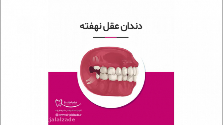 دندان عقل دکتر مرضیه جلال زاده