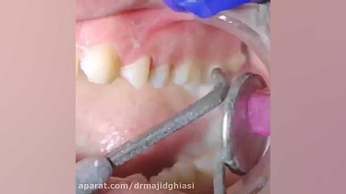 جرمگیری دندان مشهد الکترود اپتوژنزی